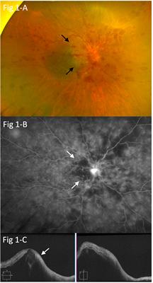 Case report: A case of unilateral combined central retinal vein occlusion, incomplete central retinal artery occlusion, and papillitis following a third dose of COVID-19 vaccination